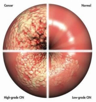 Colposcopy